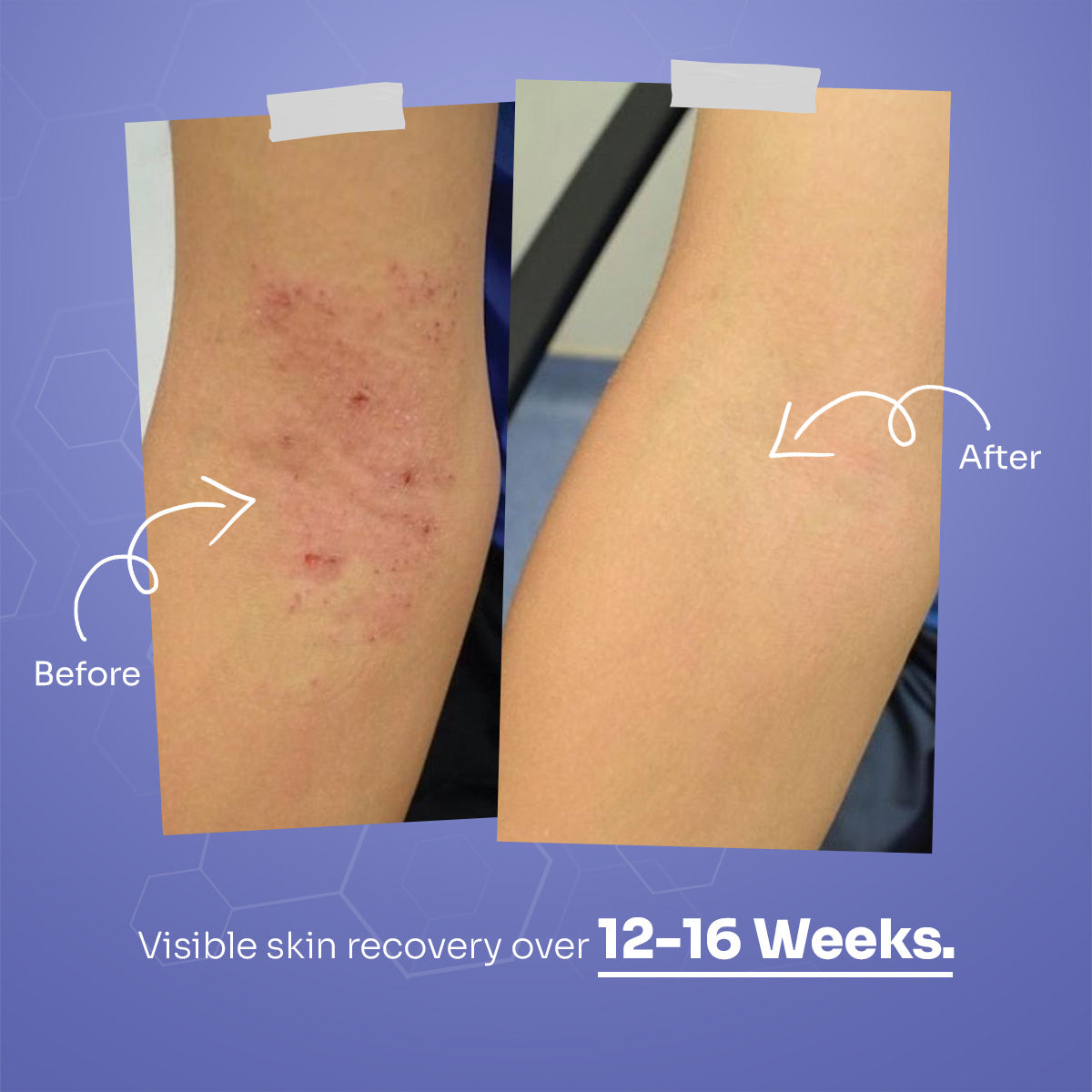 PsoRelief Complete Relief Kit