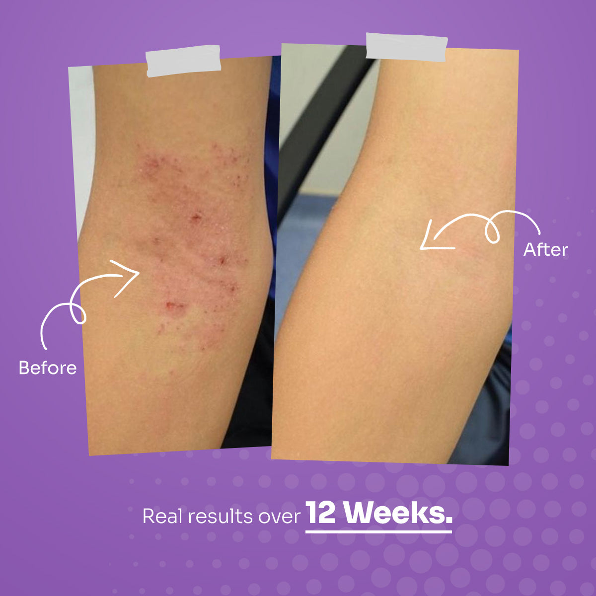 EczeSoothe Complete Relief Kit