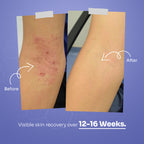 PsoRelief Complete Relief Kit