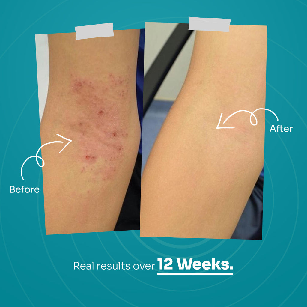 UrtiCare Complete Relief Kit